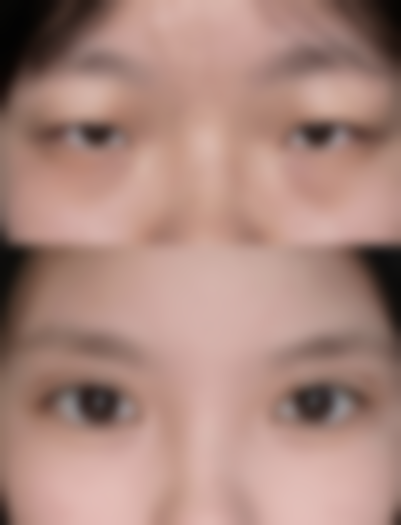 瘦脸针多久打一次可以维持恒久