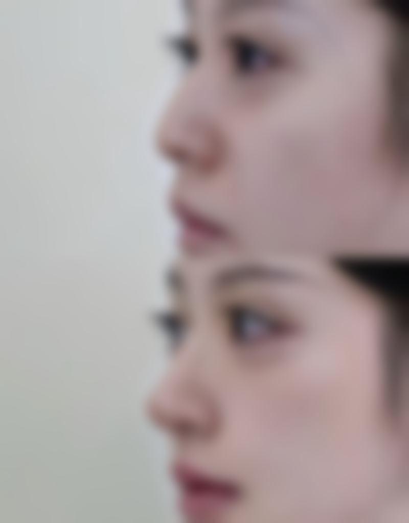 评价一：“在青岛善慈整形医院做了眼部整形，成效超出了我的预期。医生特别耐心，手术过程也特别顺利，术后修复得也快，现在眼睛变得又大又亮，真的太满意了！”