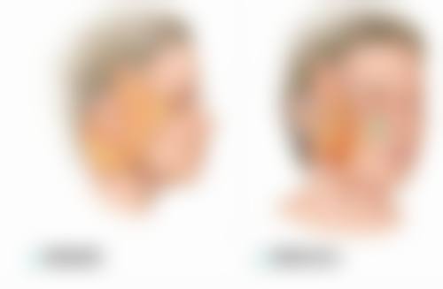 瘦脸针的危害和副作用