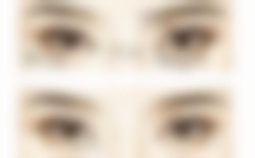 小脸针跟瘦脸针有什么区别？深度剖析两者原理、效果及适用人群，助你精准选医美方案！ 