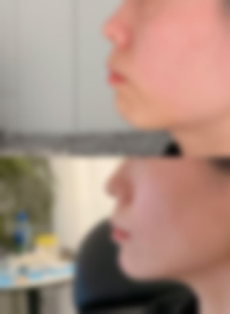 女生打美白针的特别关注