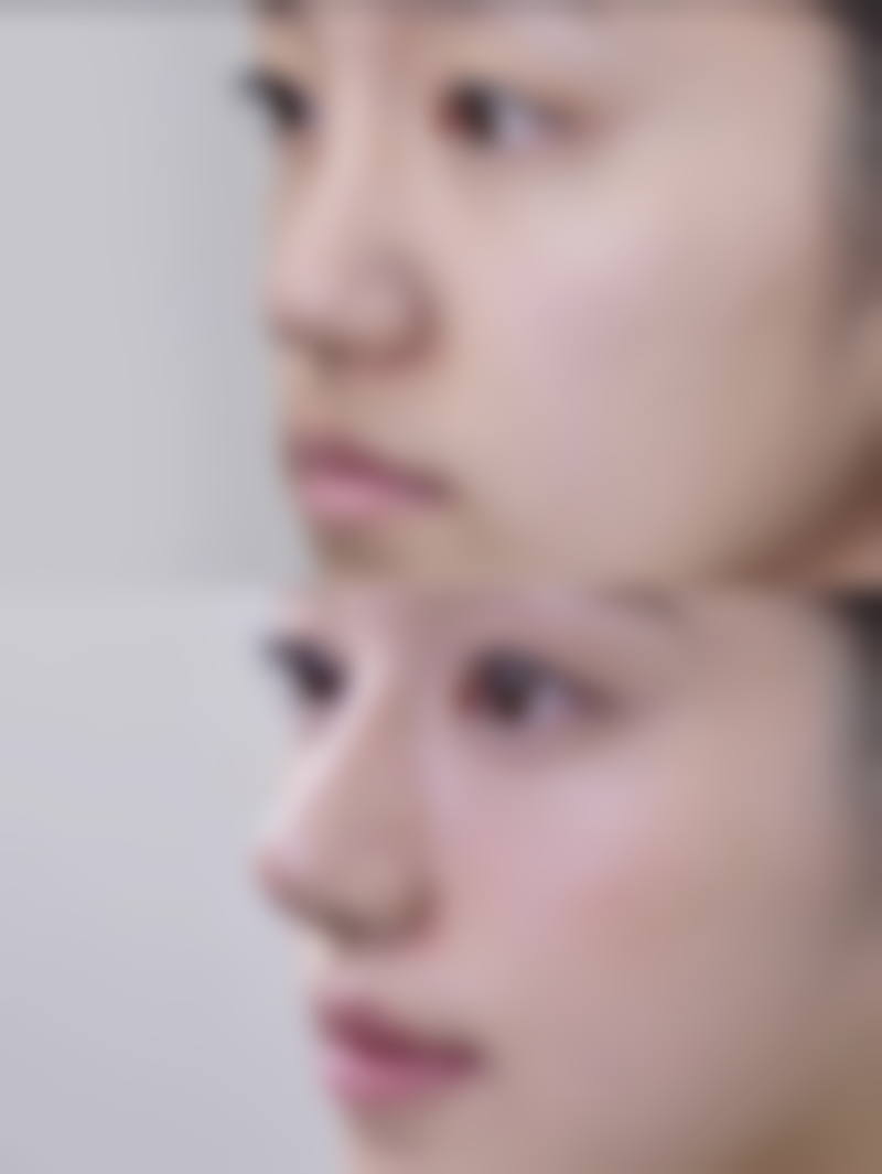 瘦脸针有没有副作用和危害