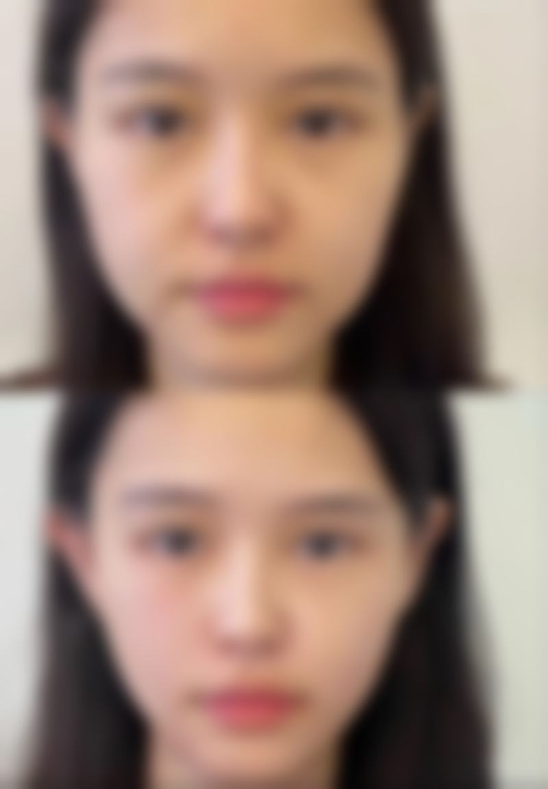 瘦脸针和小脸针真是一个原理嘛