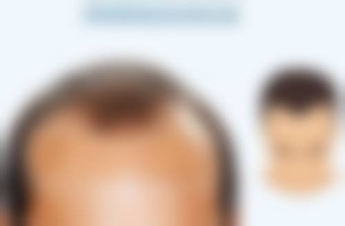 嘴唇有疤痕是否能去掉