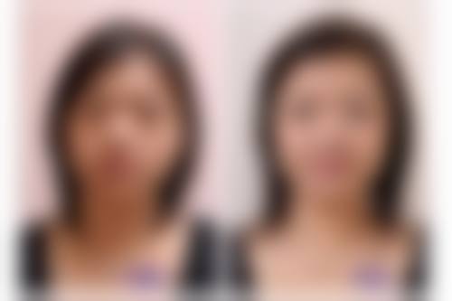 有法令纹嘴角下垂怎么办？揭秘医美4大有效方案，让你轻松告别老态，重焕青春光彩！ 