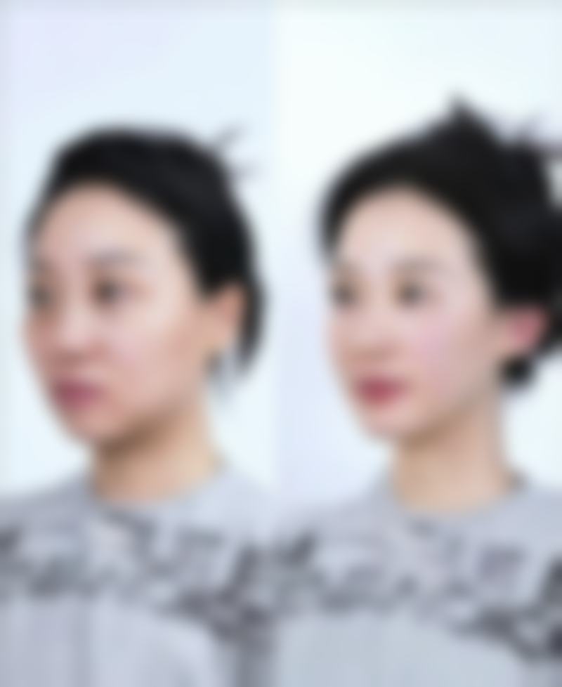 丰太阳用什么玻尿酸