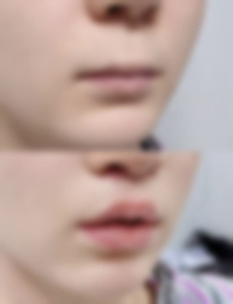 玻尿酸丰太阳多少钱?