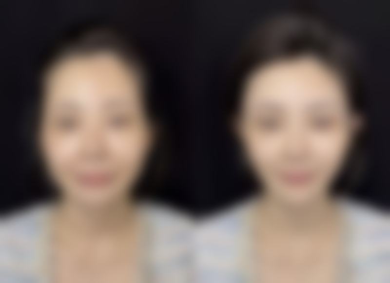 丰太阳用什么玻尿酸好