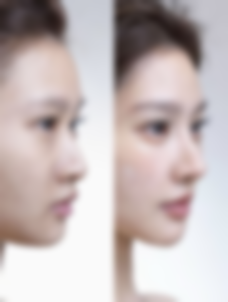 如何选择适合自己的除皱针