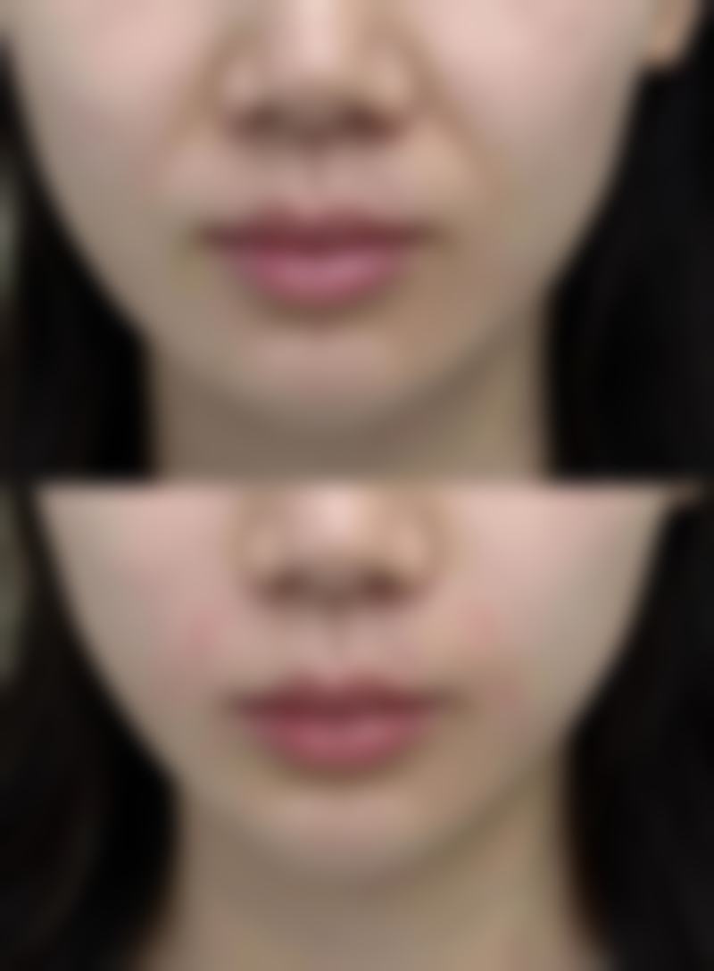 嘴巴深覆合怎么办