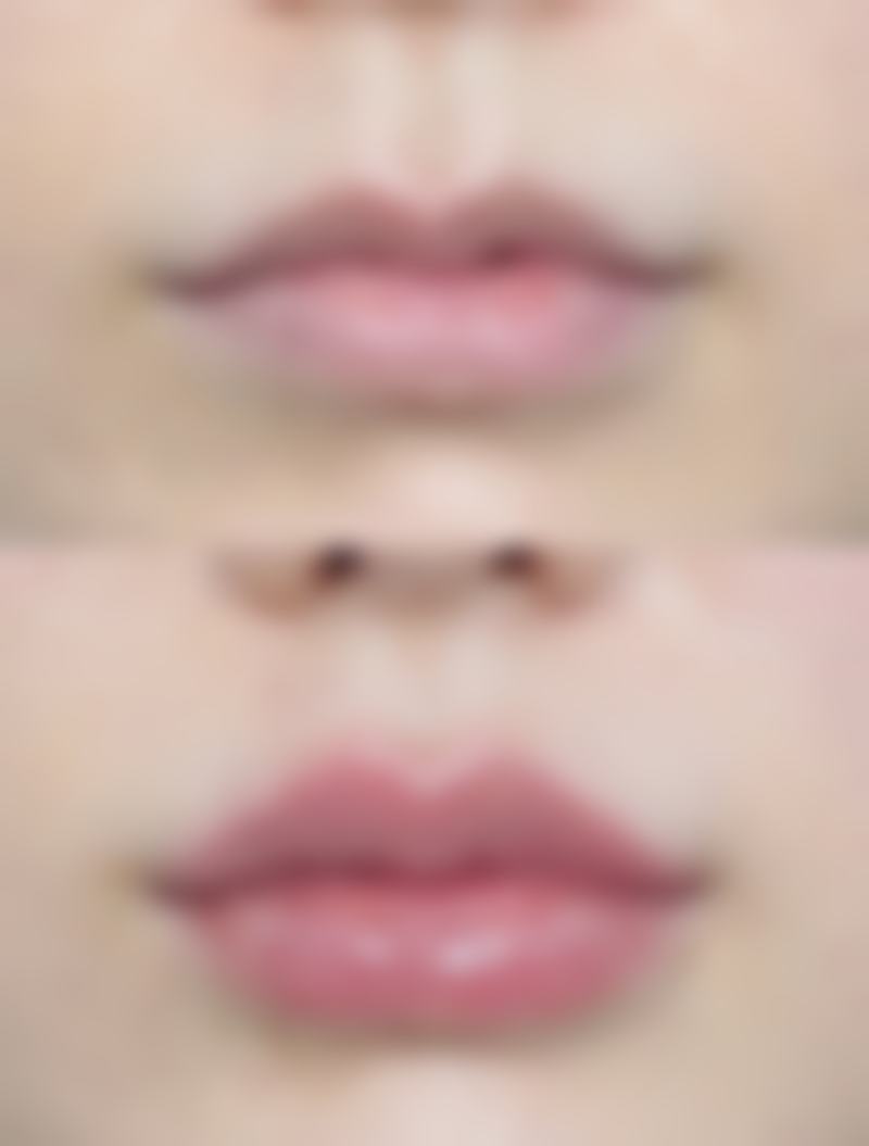 面上、中1/3皮肤松弛面部除皱术式选择