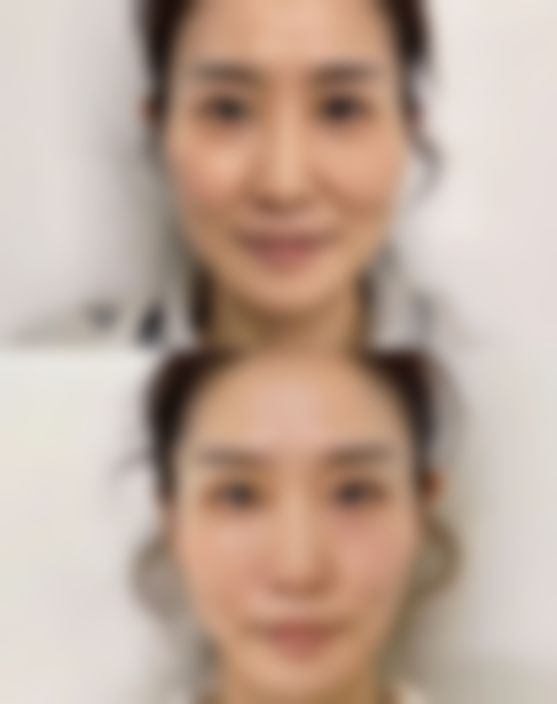 做面部除皱效果好吗？三甲医美专家揭秘：5 大常用方法效果显著，还原肌肤年轻紧致状态！ 