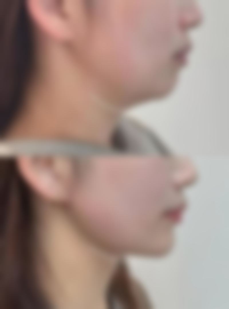 一般注射瘦脸针是多少单位？揭秘不同脸型适用的精准单位量，让你轻松拥有精致小脸！ 