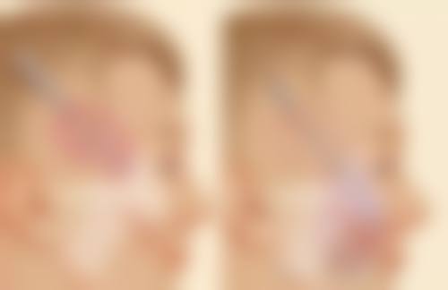 美白针打哪里白哪里吗