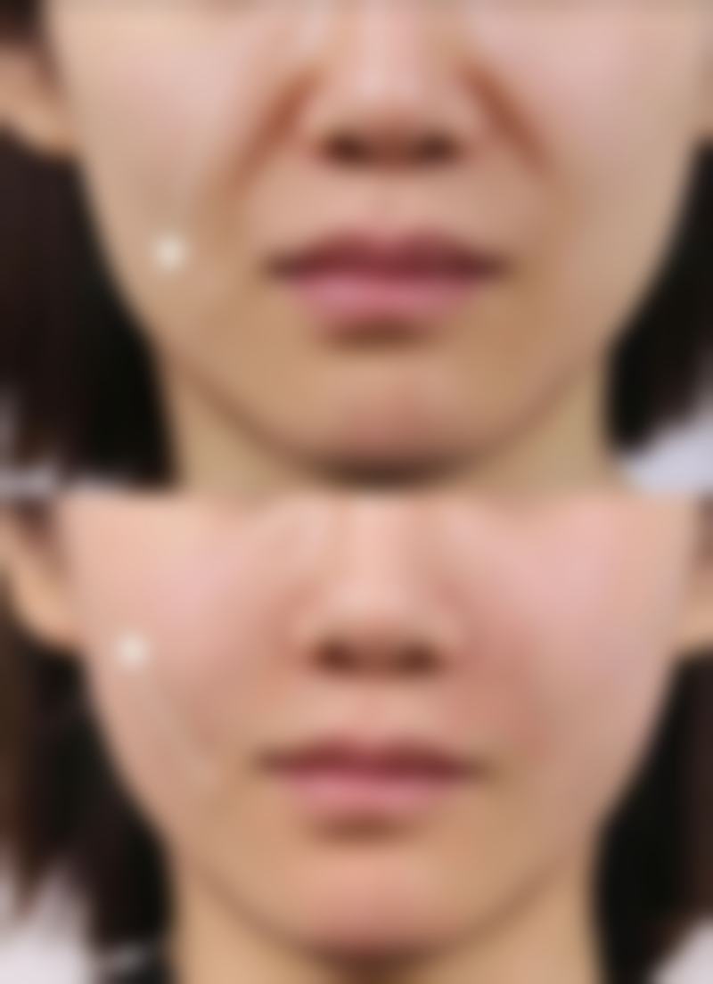 美白针哪里注射好一点