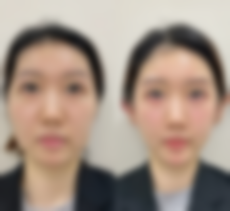 美白针哪里打更好