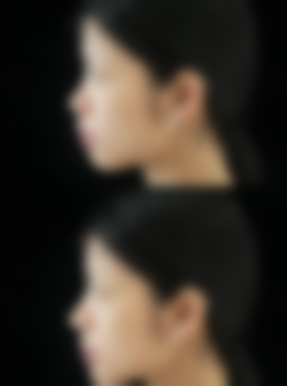 下巴歪能通过矫正牙齿改善吗