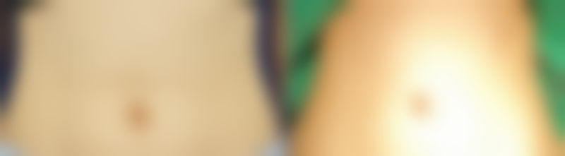 做下巴歪矫正前要知道的事