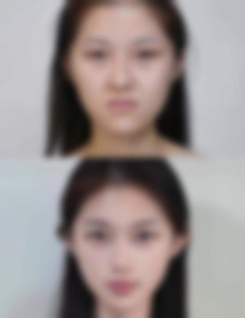 除皱有哪些副作用？揭秘3大常见风险，同时告诉你4种有效应对方法，让医美除皱更安心！ 