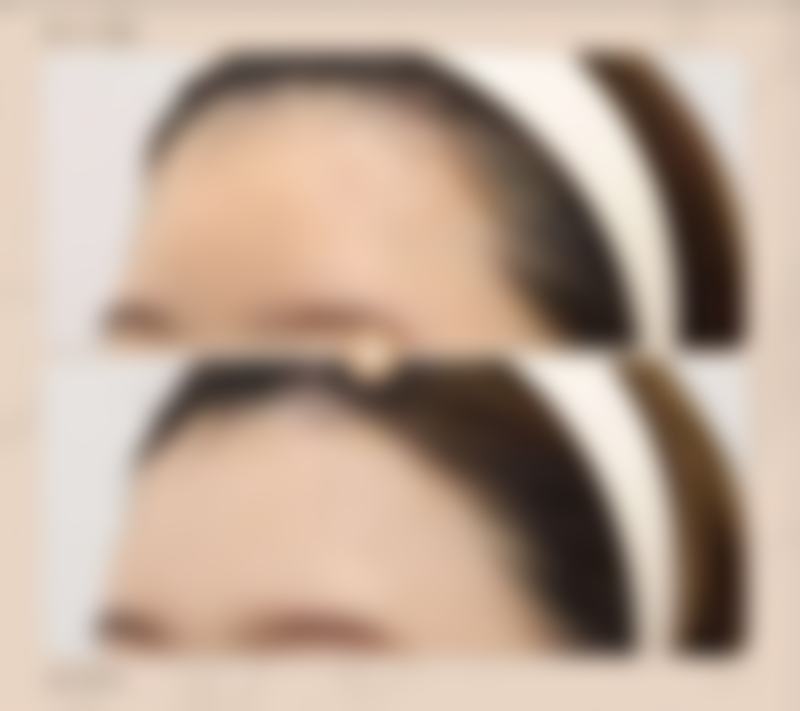 打完瘦脸针正确的睡姿