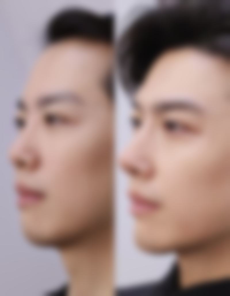 丰太阳假体亲身经历