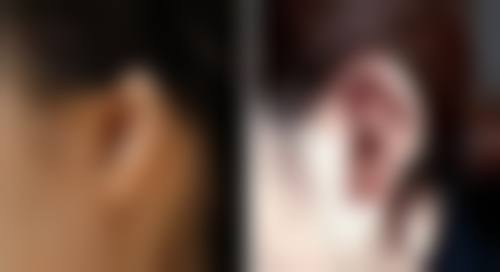 面部除皱针注射部位图