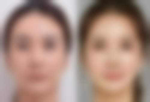 除皱针一年打几次更好