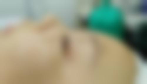 除皱针的危害和副作用