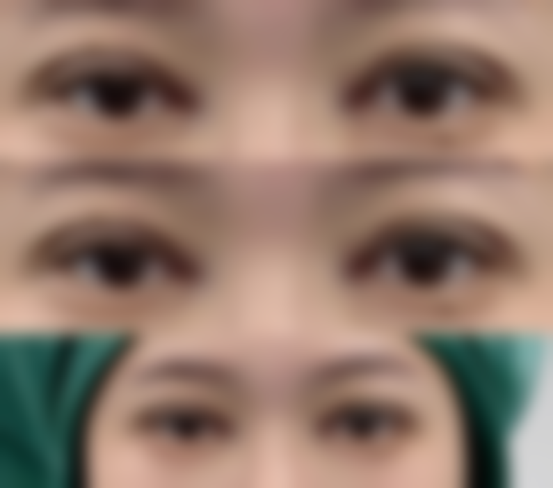 打了瘦脸针可以做面部护理吗