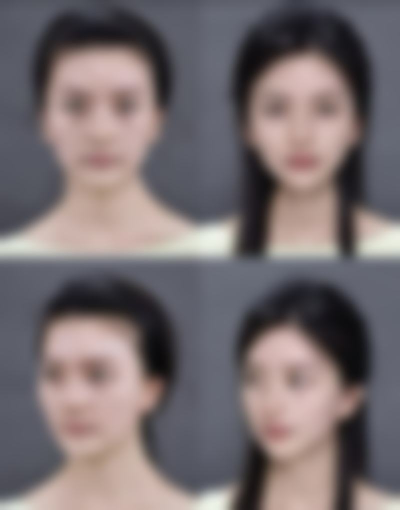 打了瘦脸针可以做其他手术吗