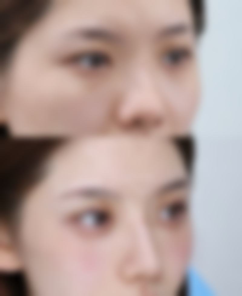 除皱针的价格一般是多少