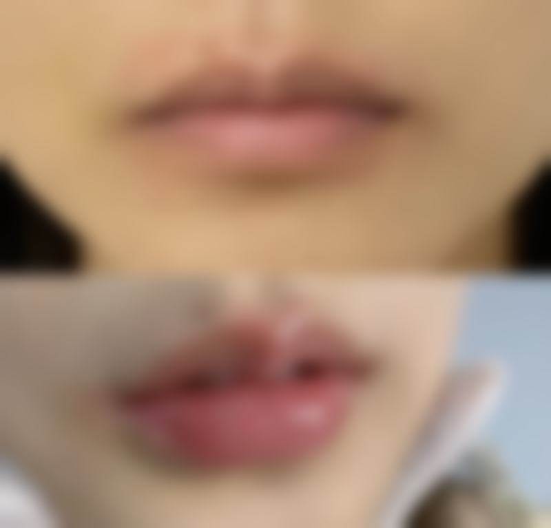 皮肤黑的人打美白针有成效吗