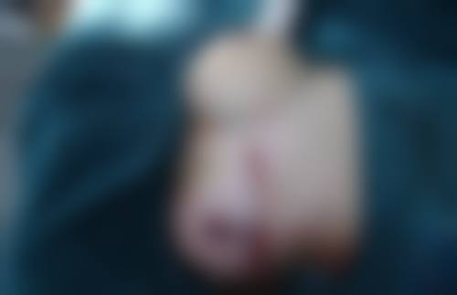 打瘦脸针一支维持多久？揭秘3 - 6个月效果背后的秘密，助你轻松拥有精致小脸！ 