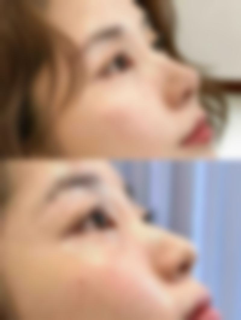 瘦脸针打几次就恒久了