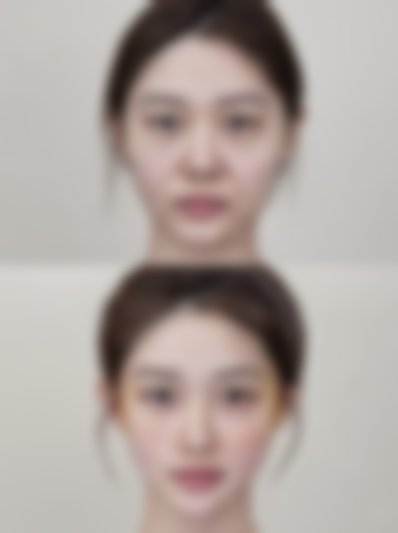 瘦脸针一般打50单位还是100单位