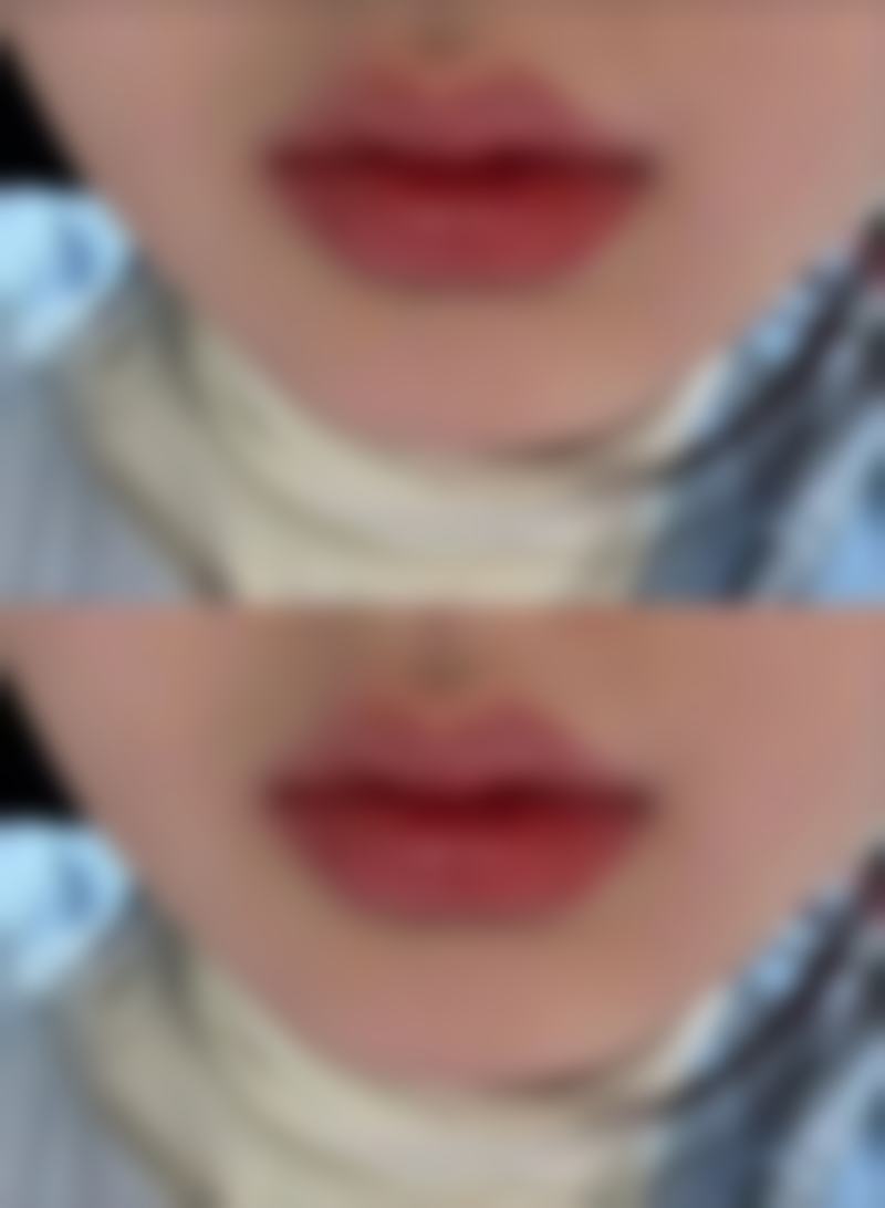 瘦脸针脸凹陷了还能修复以前吗