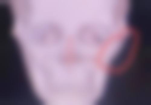 瘦脸针打一次维持多久