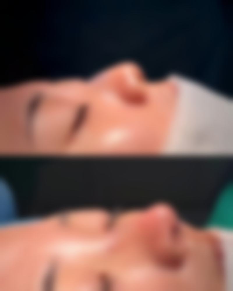 瘦脸针多久打一次成效至佳