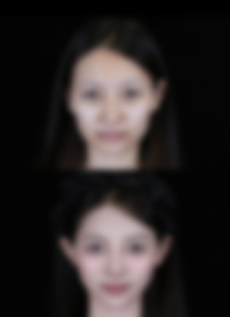 瘦脸针的危害和副作用