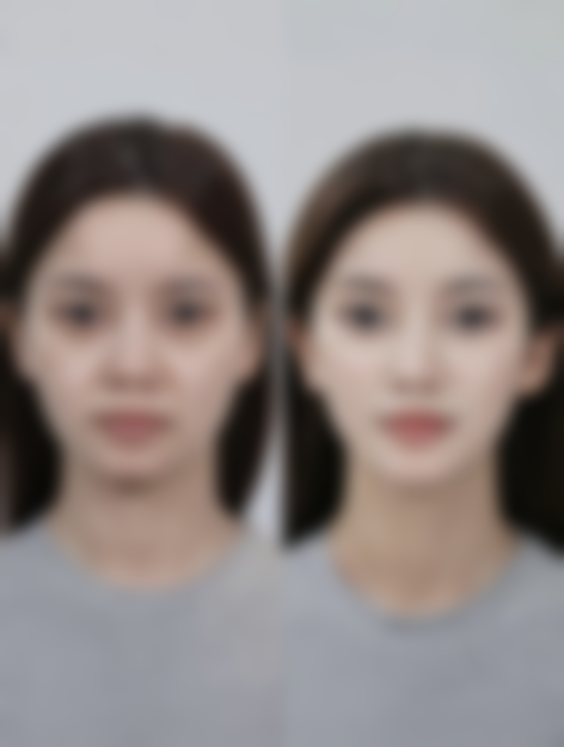 瘦脸针价格及适用情况