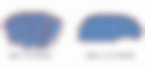 适合注射瘦脸针的人群