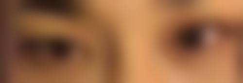 注射瘦脸针的后遗症