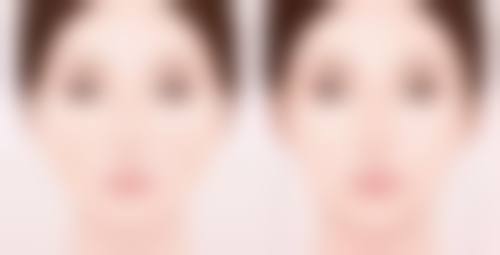 注射瘦脸针的注意事项