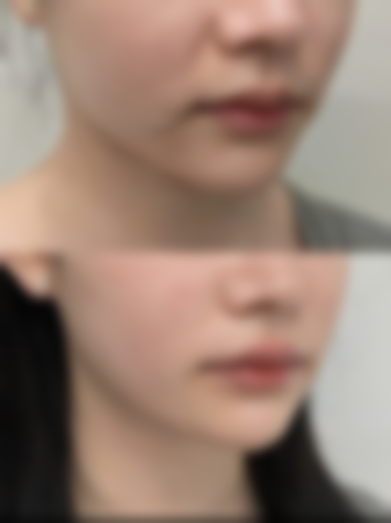 打了瘦脸针之后肿了好几天正常吗