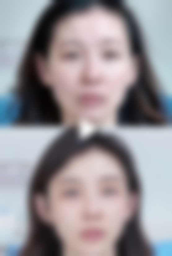 美白针能维持多久成效