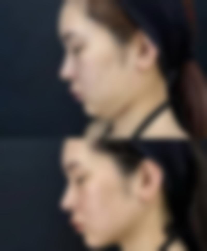 瘦脸针的成效和术后注意事项