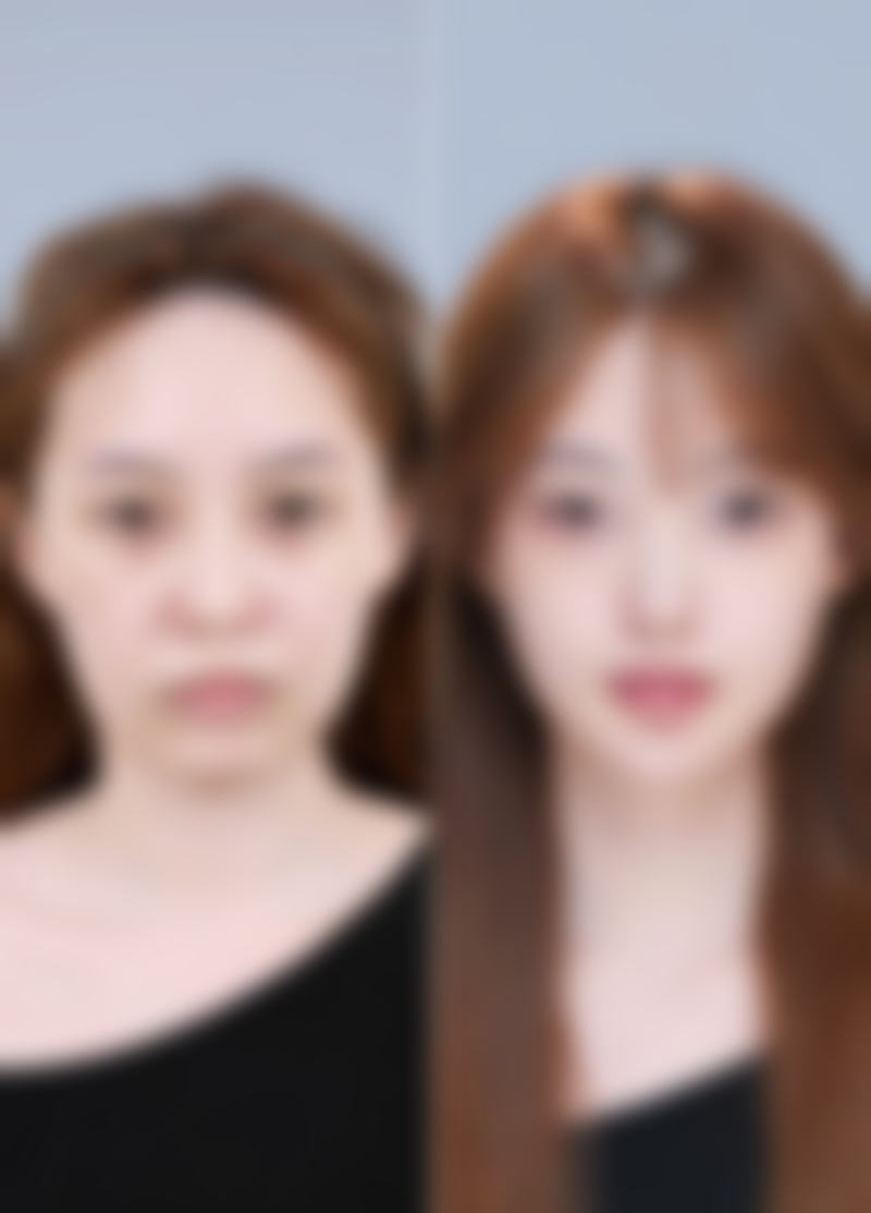 什么情况不能植发际线