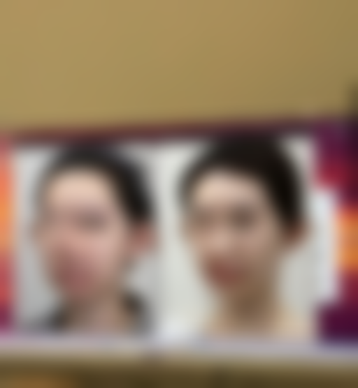 打完瘦脸针多久可以平躺