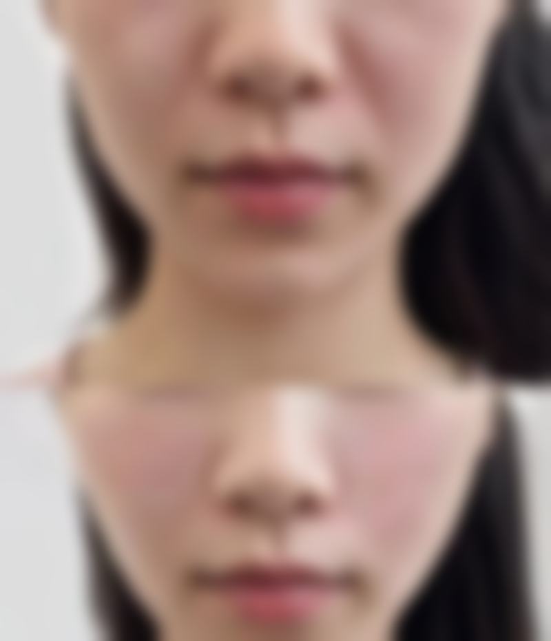 环切包茎手术多久可以手淫