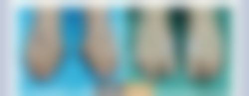 嘴向外凸矫正的注意事项